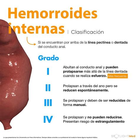 fotos reales de hemorroides|Fotos de hemorroides externas e internas (almorranas)